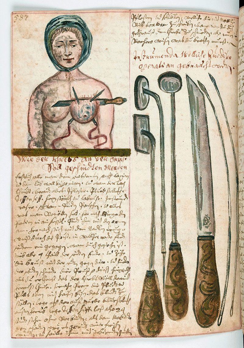 WMS_990_Breast_operation_and_instruments_Wellcome_L0041077